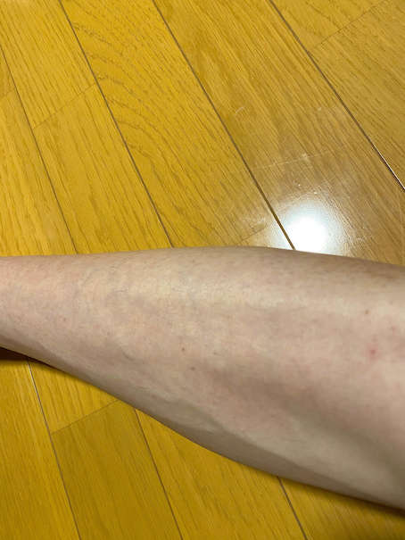 全身脱毛した後のすねの毛