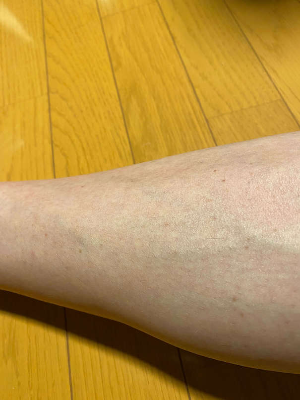 全身脱毛した後のすねの毛